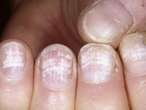 Изменения ногтей на руках. Изменение поверхности и структуры