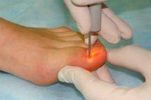 На ногах неровные ногти. Лечение волнистости ногтей 05 На ногах неровные ногти. Лечение волнистости ногтей 05