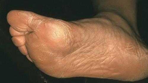 Вогнутые ногти на ногах. Классификация и развитие патологии