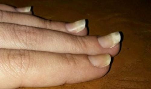 Изменения ногтей на руках. Изменение поверхности и структуры