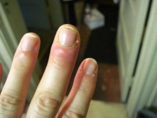 Очень сохнет кутикула и кожа вокруг ногтей на руках. Очень сухая кутикула