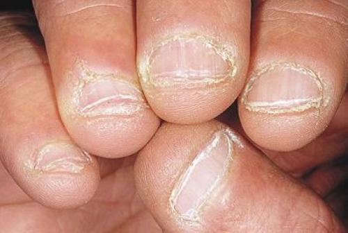 Сухая кутикула и кожа рук. Шелушащаяся сухая кожа