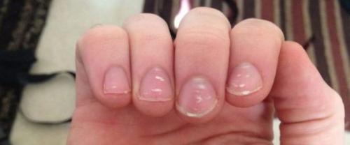 Изменения ногтей на руках. Изменение поверхности и структуры
