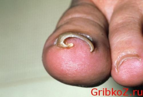 Сколько отрастает ноготь на большом пальце ноги. Причины, предрасполагающие к появлению грибка на ногтях