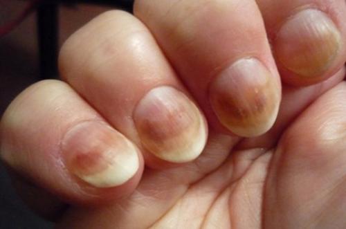 О чем сигнализируют пятна разных цветов на ногтях?