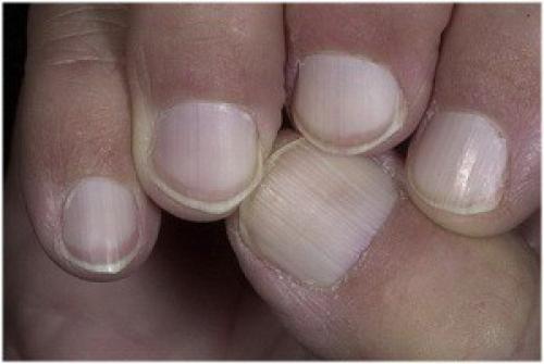 Дырки на ногтях рук причины. Причины появления и симптомы грибка ногтей на руках