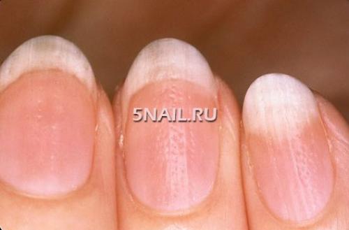 Волны на ногтях рук причины. Факторы появления неровностей на ногтях