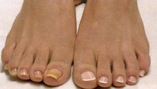 Отмирает ноготь на ноге. Симптомы онихолизиса