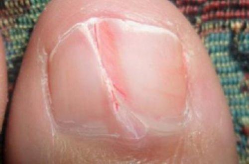 На ногах неровные ногти. Лечение волнистости ногтей 03 На ногах неровные ногти. Лечение волнистости ногтей 03