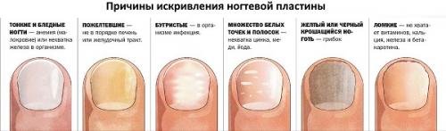 Неровный ноготь на большом пальце. Классификация 05 Неровный ноготь на большом пальце. Классификация 05