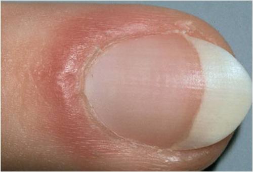 Ванночка для кожи вокруг ногтей. Воспаление кутикулы и методы его лечения