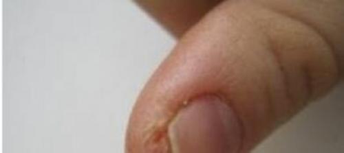 Трескается кожа на пальцах рук возле ногтей. Ищем причину появления трещинок
