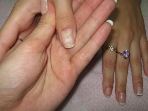 Вмятины на ногтях рук причины. Грибок