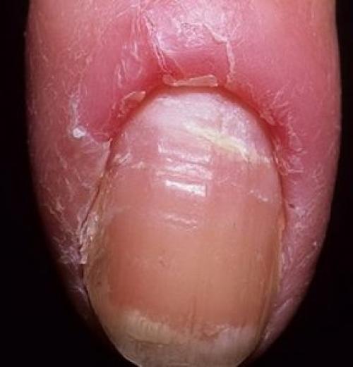 Как называется кожа вокруг ногтя. Виды нарывов на пальцах рук или ног