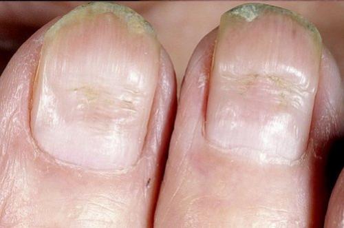 На ногах бугристые ногти. Лечение волнистости ногтей 03 На ногах бугристые ногти. Лечение волнистости ногтей 03