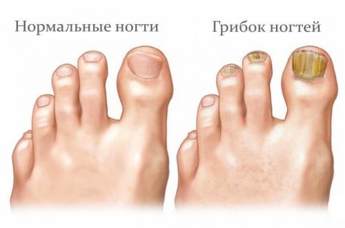 Негрибковые заболевания ногтей на ногах. Почему развивается онихомикоз ногтевых пластин