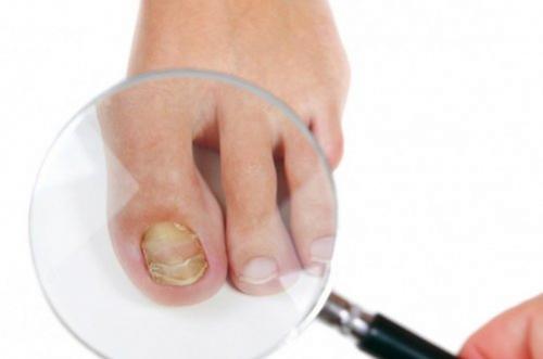 На ногах неровные ногти. Лечение волнистости ногтей 04 На ногах неровные ногти. Лечение волнистости ногтей 04