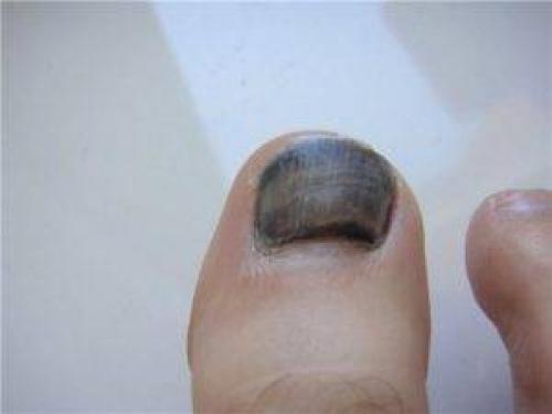 Отмирает ноготь на ноге. Симптомы онихолизиса