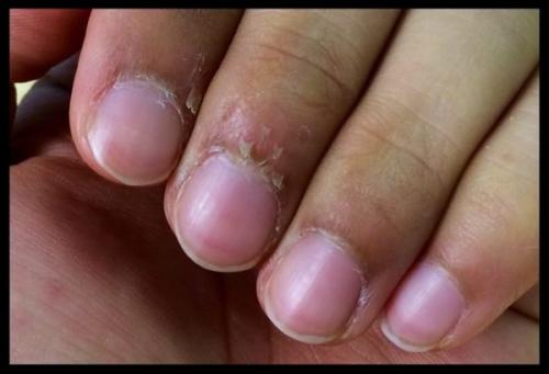 Очень сохнет кутикула и кожа вокруг ногтей на руках. Очень сухая кутикула