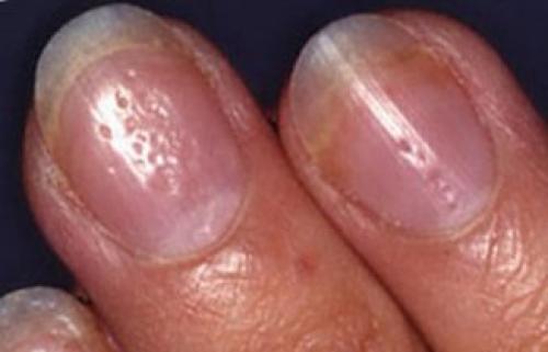 Синдром стиральной доски: что означают вмятины и бороздки на ногтях