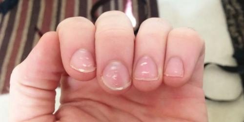 Точечные углубления на ногтях. Почему появляются точки на ногтях