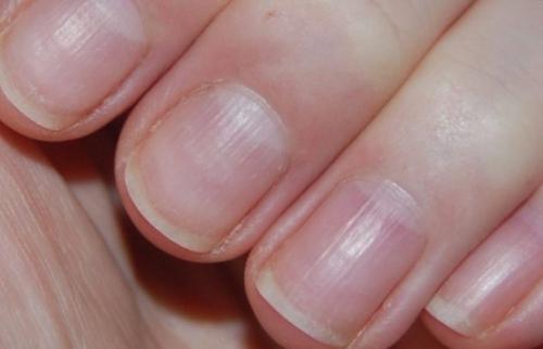 Точечные углубления на ногтях. 5 главных причин возникновения борозд на ногтях