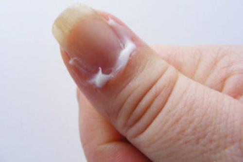 Что делать если сохнет кожа вокруг ногтей. Очень сухая кутикула