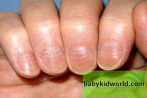 Неровные ногти на ногах причина. Заболевания ногтей 07 Неровные ногти на ногах причина. Заболевания ногтей 07