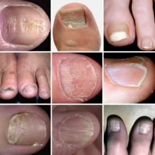 Неровные ногти на ногах причина. Заболевания ногтей
