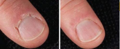 Что делать если сохнет кожа вокруг ногтей. Очень сухая кутикула