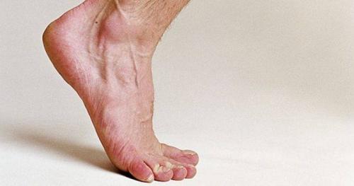 Почему ногти выпадают на ногах. Причины, вызывающие онихолизис 05