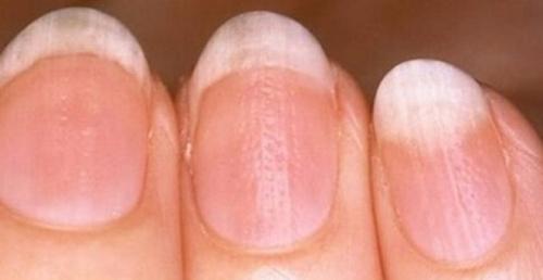 Точечные углубления на ногтях. 5 главных причин возникновения борозд на ногтях