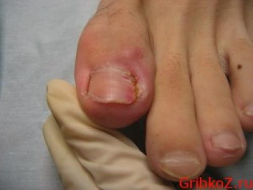 Сколько отрастает ноготь на большом пальце ноги. Причины, предрасполагающие к появлению грибка на ногтях