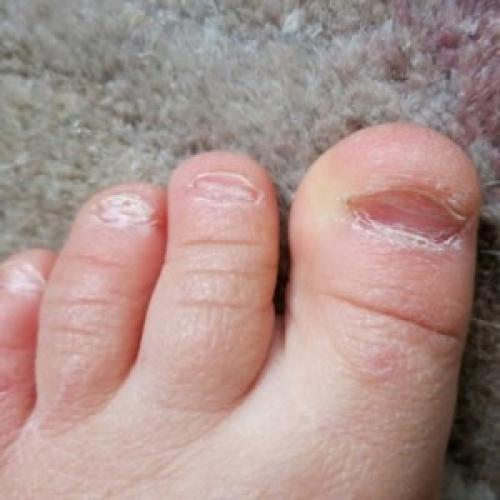 Неровные ногти на ногах причина. Заболевания ногтей 08