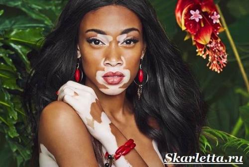 Красота на руках причины. Пигментные пятна на руках. Причины появления и борьба с пигментными пятнами на руках