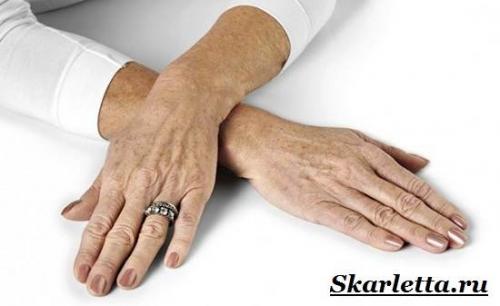 Красота на руках причины. Пигментные пятна на руках. Причины появления и борьба с пигментными пятнами на руках