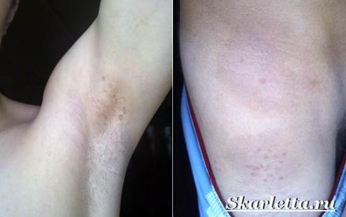 Красота на руках причины. Пигментные пятна на руках. Причины появления и борьба с пигментными пятнами на руках