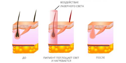 Как убрать волосы в зоне глубокого бикини. Как сделать глубокое бикини в домашних условиях
