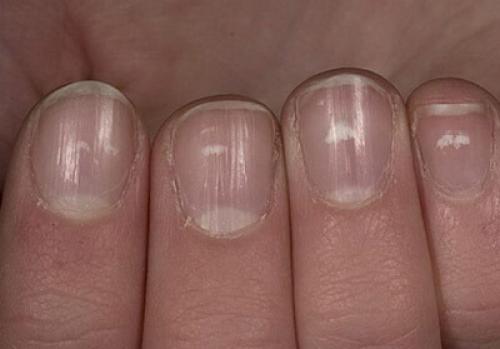 Бугристые ногти, что это. Деформация ногтей: причины