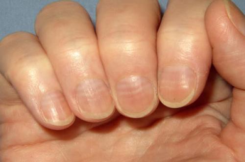 Бугристые ногти, что это. Деформация ногтей: причины