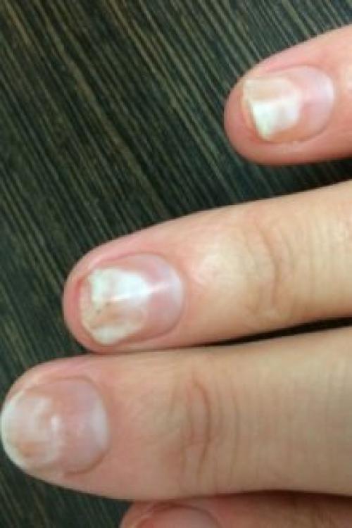 Почему цветной гель-лак отслаивается от базы. Почему отслаивается гель-лак от ногтей: причины и особенности