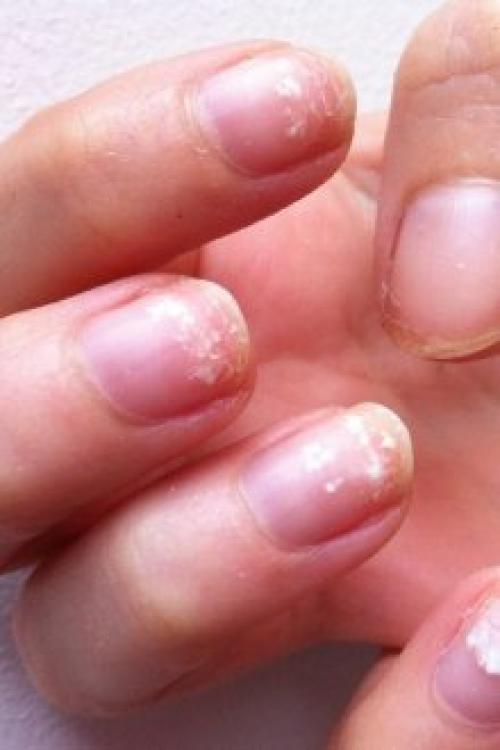 Почему отслаивается гель-лак со свободного края. Почему отслаивается гель-лак от ногтей: причины и особенности