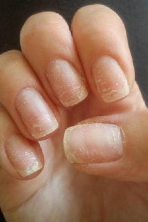 Почему отслаивается гель-лак со свободного края. Почему отслаивается гель-лак от ногтей: причины и особенности