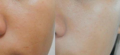 Лучшие отбеливающие маски для лица. Рекомендацию по осветлению кожи дома