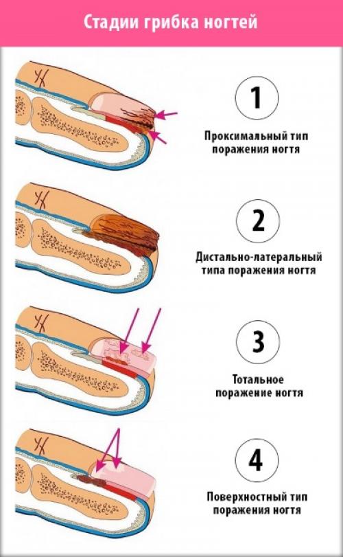 Укрепление ногтей гелем пошагово. Как укрепить ногти гелем под гель лак. Какие гели лучше использовать, как проходит процедура пошагово. Инструкция с фото