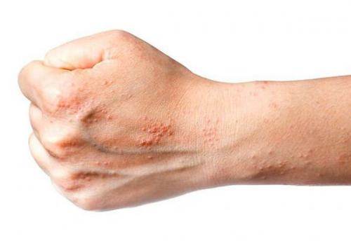 Почему вокруг ногтей сохнет кожа: основные причины и решения 04