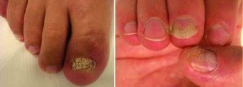 Симптом наперстка на ногтях. Классификация и симптомы псориаза ногтей 02 Симптом наперстка на ногтях. Классификация и симптомы псориаза ногтей 02