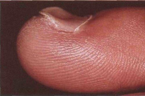 Дырка на ногте. Лечение подногтевой гематомы 03 Дырка на ногте. Лечение подногтевой гематомы 03