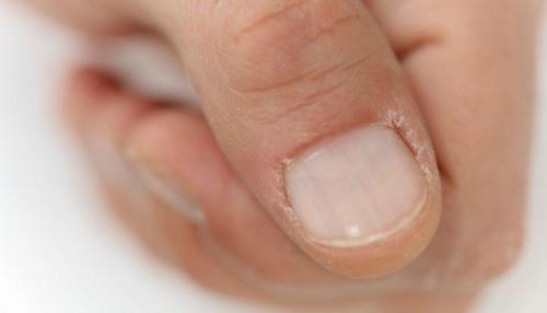 Как определить, что кутикула начала сохнуть. Почему сохнет кутикула: причины появления, как определить и исправить проблему (полезные советы)