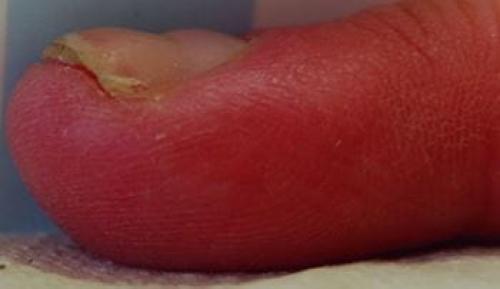 Ямки на ногтях руки. Классификация и симптомы линий Бо 03